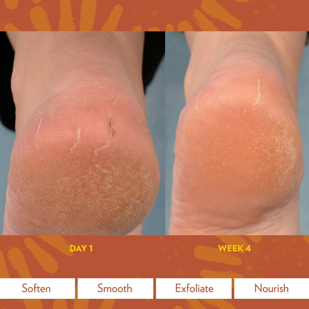 Epoch® Sole Solution® Foot Treatment