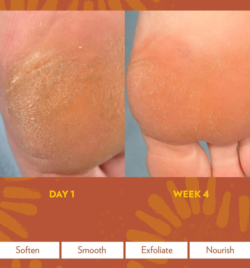 Epoch® Sole Solution® Foot Treatment